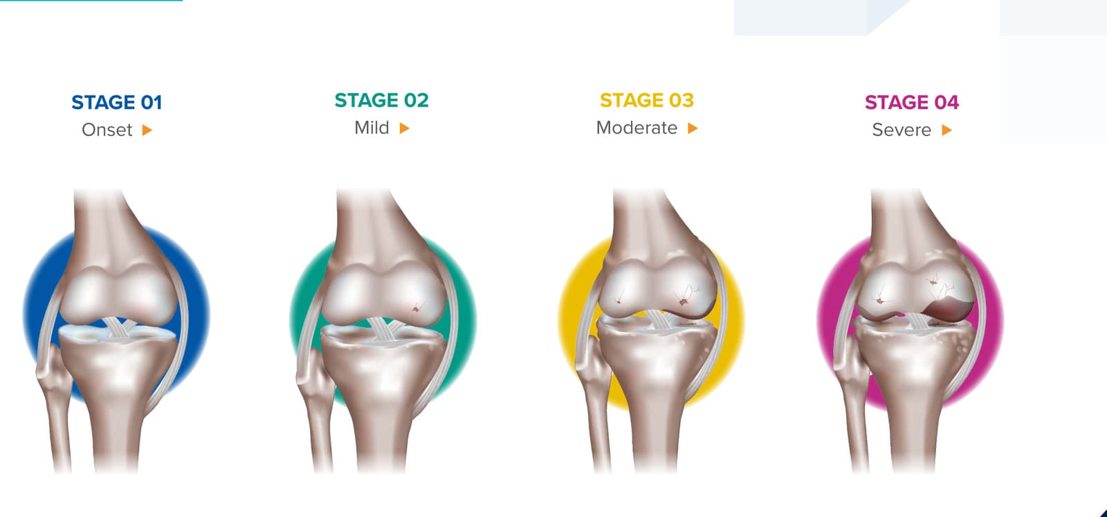 Four-stage osteoarthritis knee progression diagram (Onset, Mild, Moderate, Severe) used in the nSTRIDE patient marketing campaign